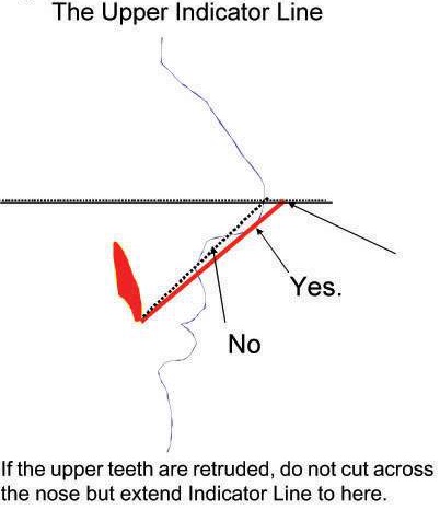 Indicator Line on a Retruded Maxilla