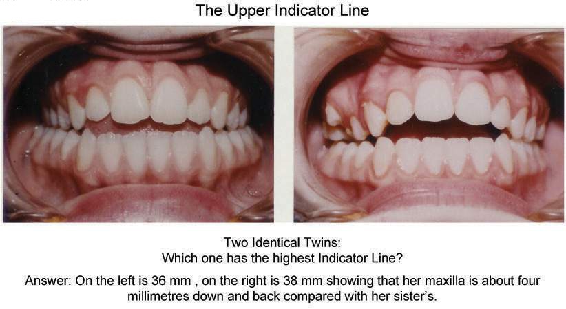 Indicator Line on a Retruded Maxilla